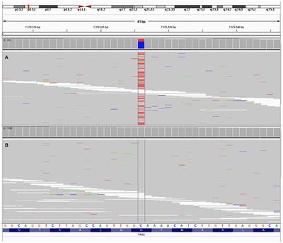 Clonal Hematopoiesis From Next Generation Sequencing of Plasma From a Patient With Lung Adenocarcinoma: A Case Report